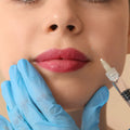 PRF Injections – Nasolabial Folds