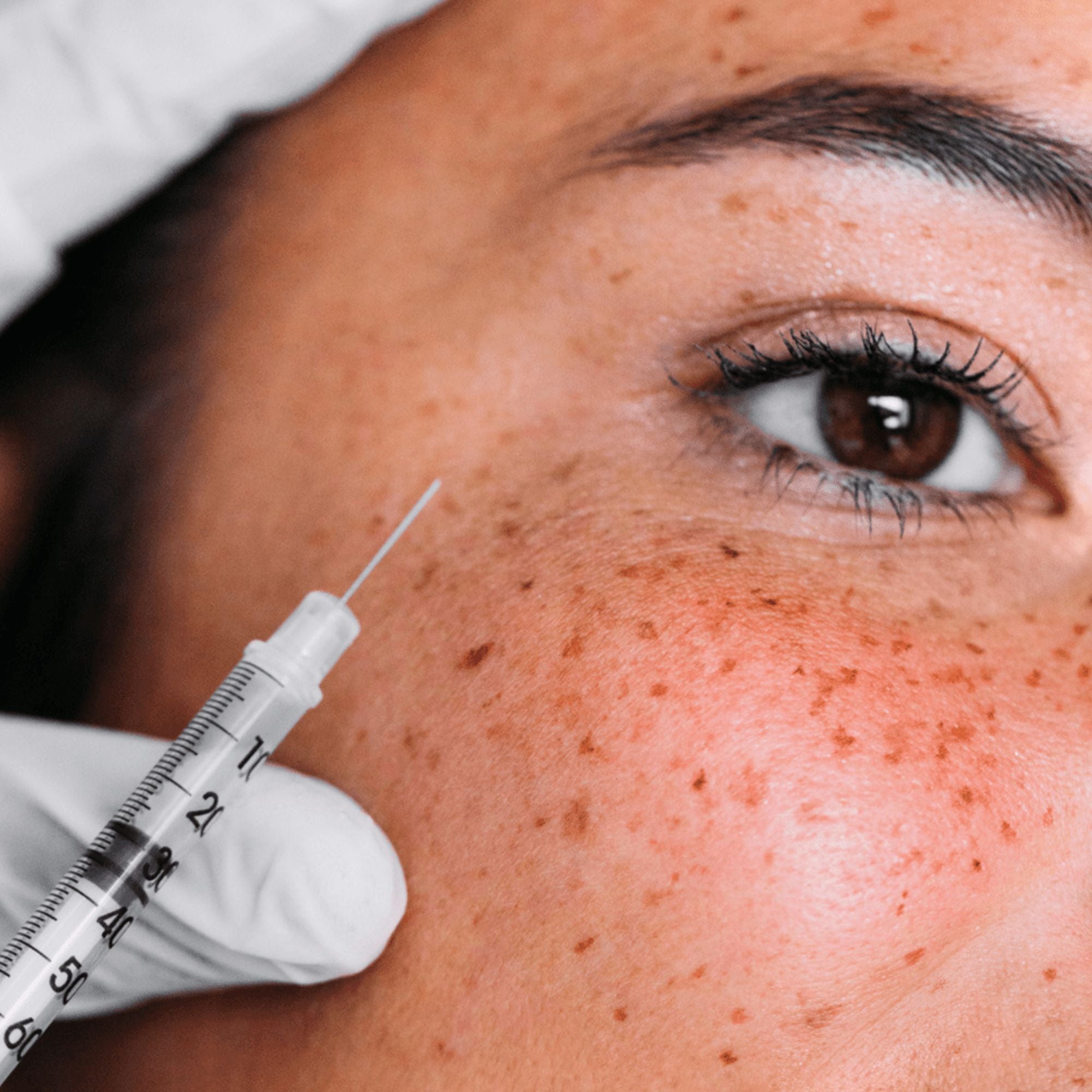 PRP – Tear Troughs