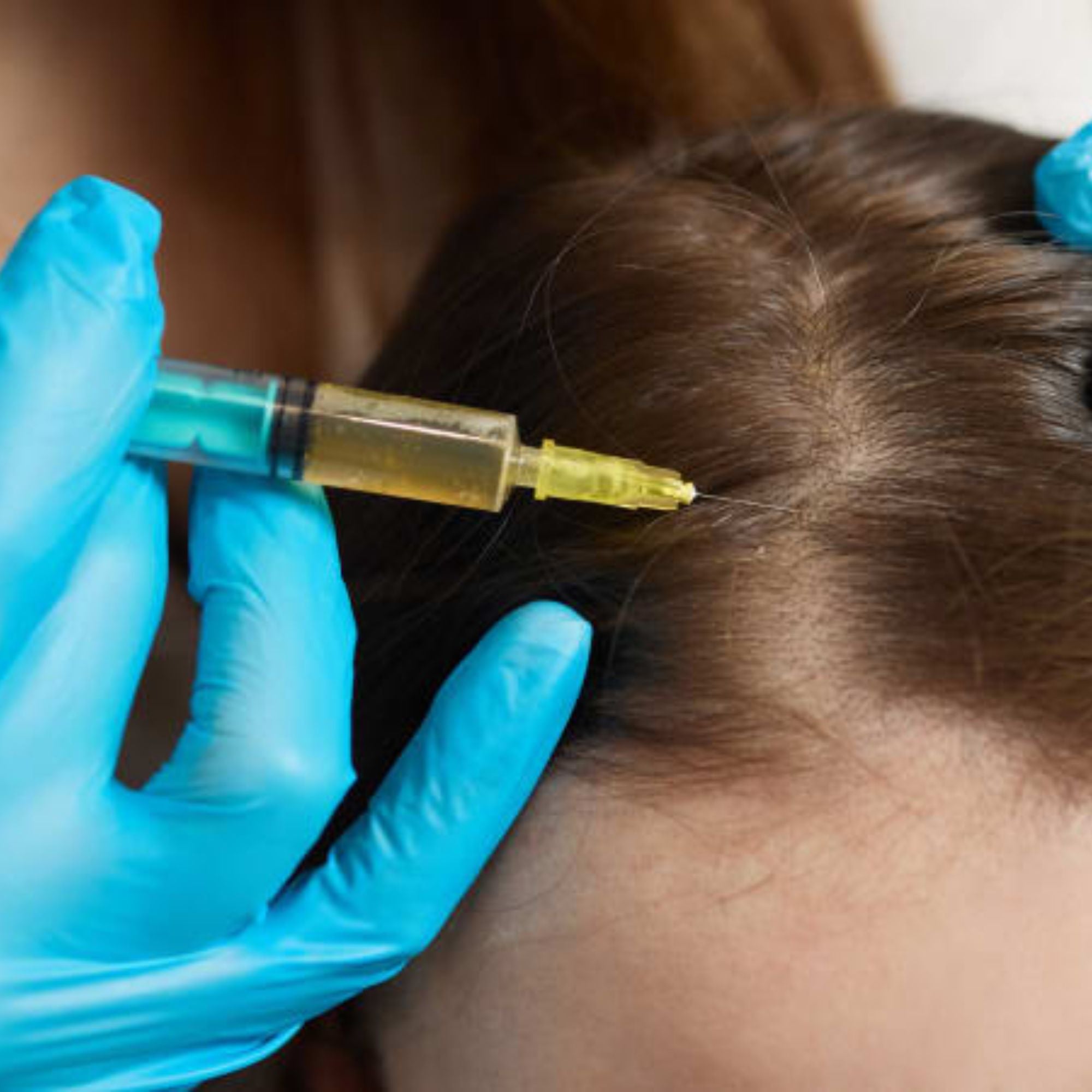 PRP Hair Restoration
